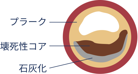 慢性冠症候群（安定冠動脈疾患）