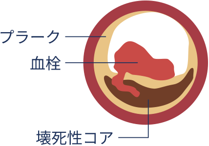 急性冠症候群