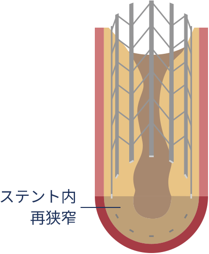 ベアメタルステント（BMS）