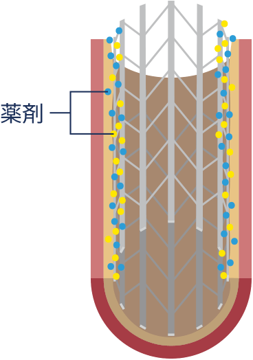薬剤溶出性ステント（DES）