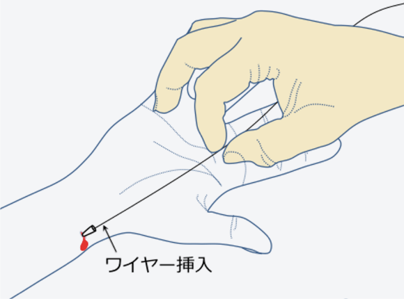 穿刺