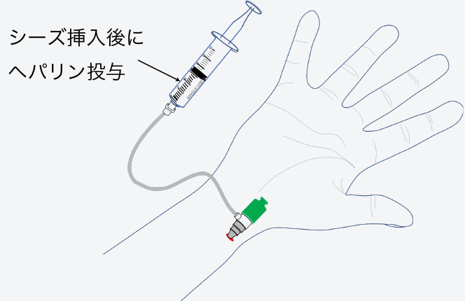 抗凝固薬の投与