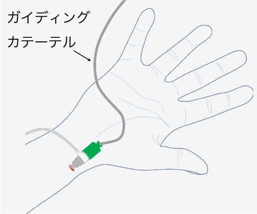 ガイディングカテーテルの挿入