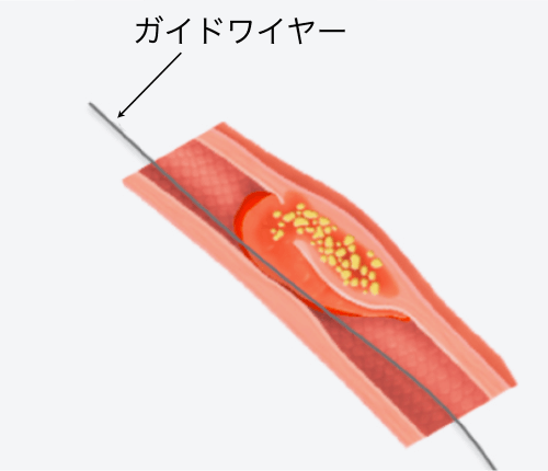 ガイドワイヤーの挿入 図b