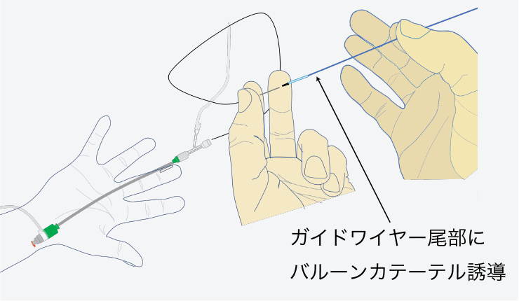 ガイドワイヤーの挿入 図c