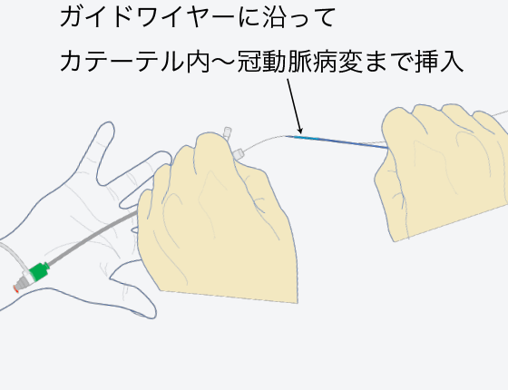 バルーンカテーテル挿入