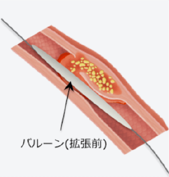 バルーン拡張2