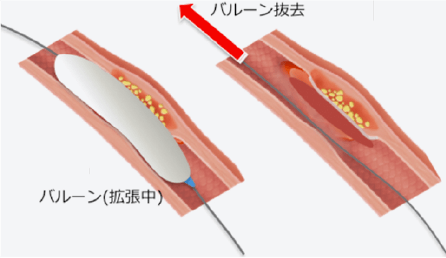 バルーン拡張3