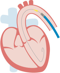 経大腿アプローチ（TF）：バルーン拡張型1