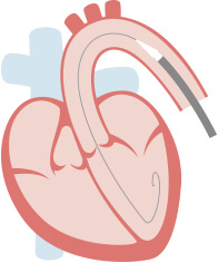 経大腿アプローチ（TF）：自己拡張型1_1