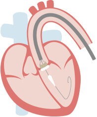 経大腿アプローチ（TF）：自己拡張型1_2