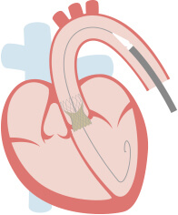 経大腿アプローチ（TF）：自己拡張型2_3