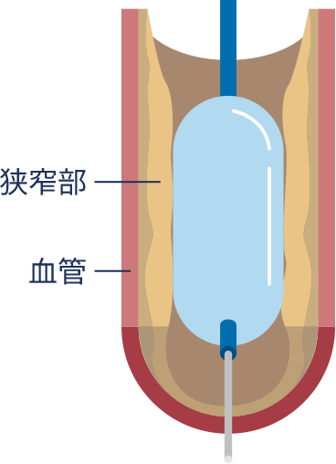 バルーン形成術（POBA）