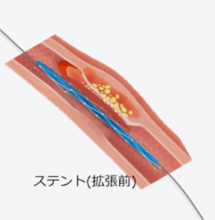 ステントの設置1
