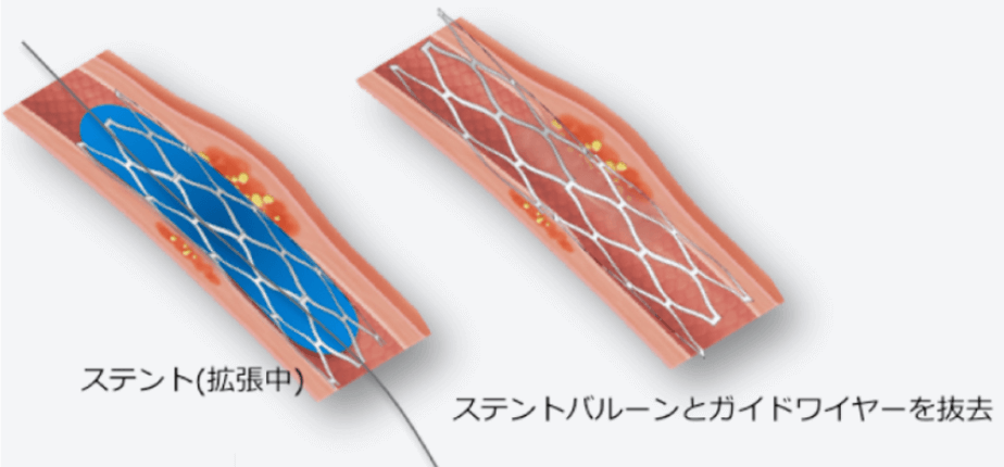 ステントの設置1